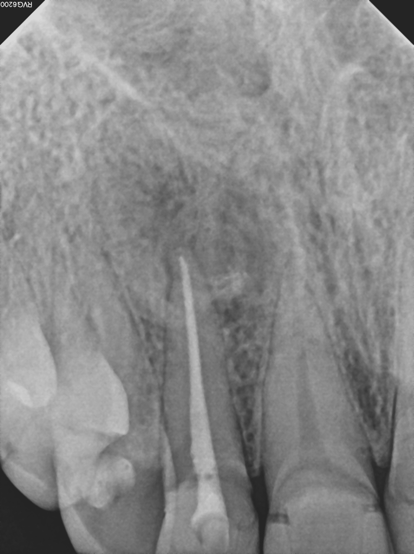 5_9 mon recall (pt moved away)