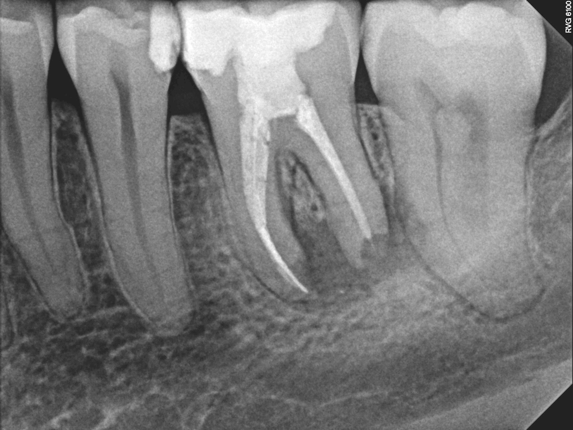 1_Case7 PreOp1 11-24-2014