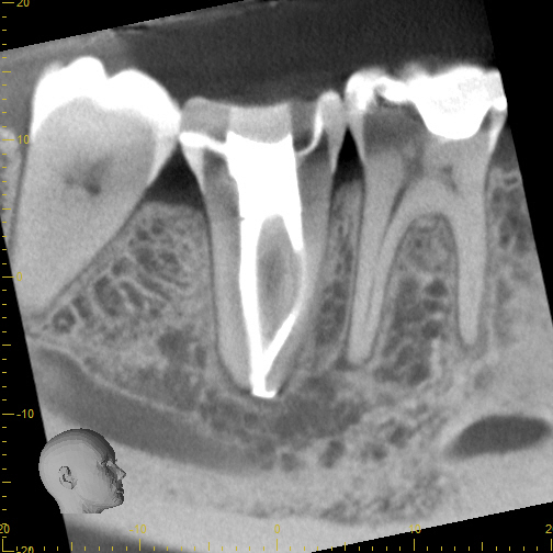 8_recall 1 yr CBCT